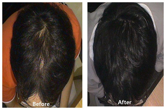 Hair-Restoration