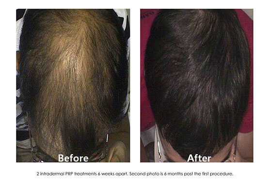 Hair-Restoration